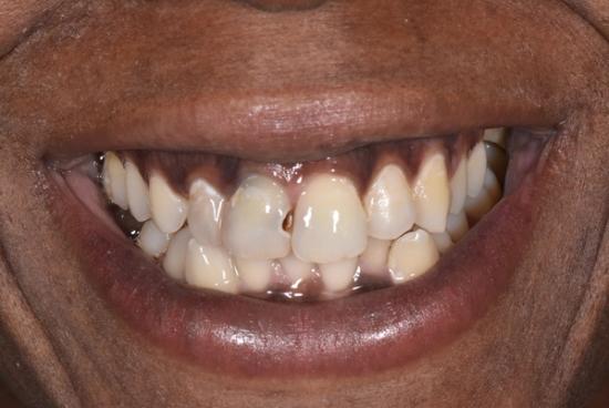 a close up of a person 's teeth with a broken tooth .