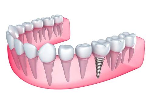 a 3d rendering of a dental implant in a lower jaw .