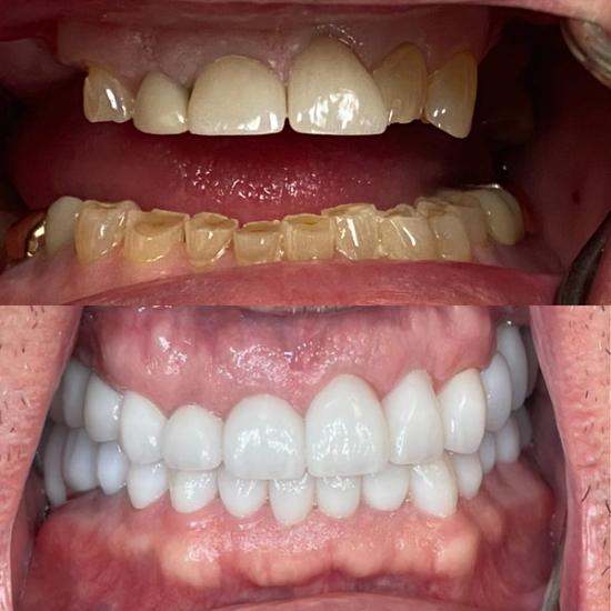 a before and after picture of a person 's teeth .