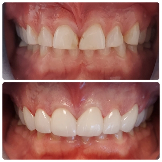 a before and after photo of a person 's teeth