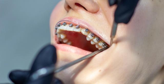 a woman with braces is getting her teeth examined by a dentist .