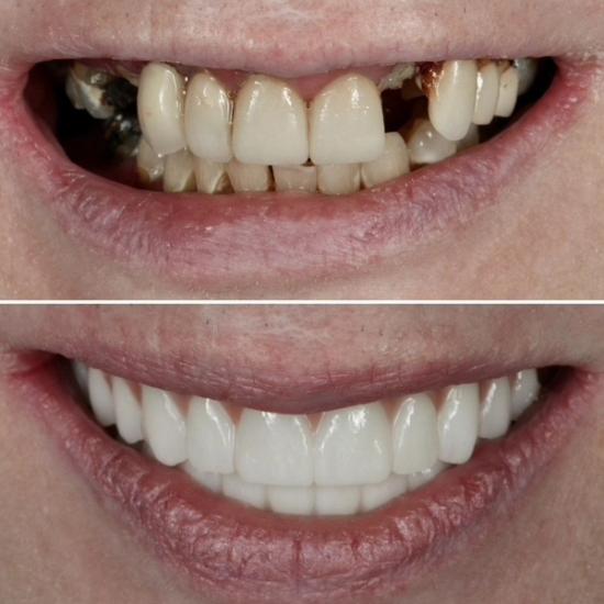 a before and after photo of a woman 's teeth .