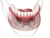 a computer generated image of a full denture with dental implants .