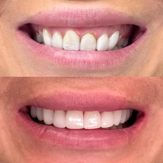 a before and after photo of a woman 's teeth .