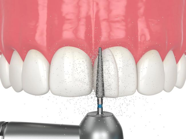 a dental drill is being used to remove a tooth .