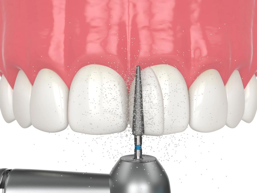 a dental drill is being used to remove a tooth .
