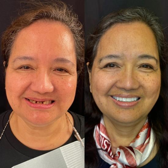Before and after photo of a woman's smile: left shows discolored, uneven teeth; right shows a confident smile with bright, perfectly aligned white teeth.
