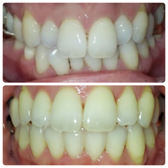 a before and after photo of a person 's teeth