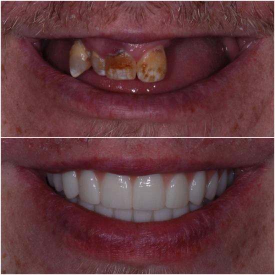 Before and after close-up of a mouth, showing decayed and missing teeth in the top panel and a full set of white, healthy teeth in the bottom panel.