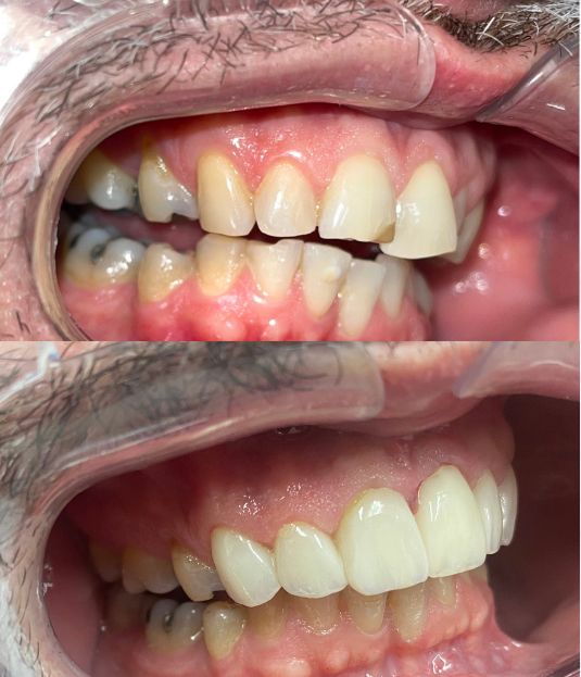 a before and after picture of a person 's teeth .