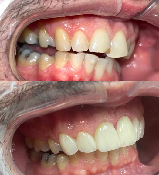 a before and after picture of a person 's teeth .