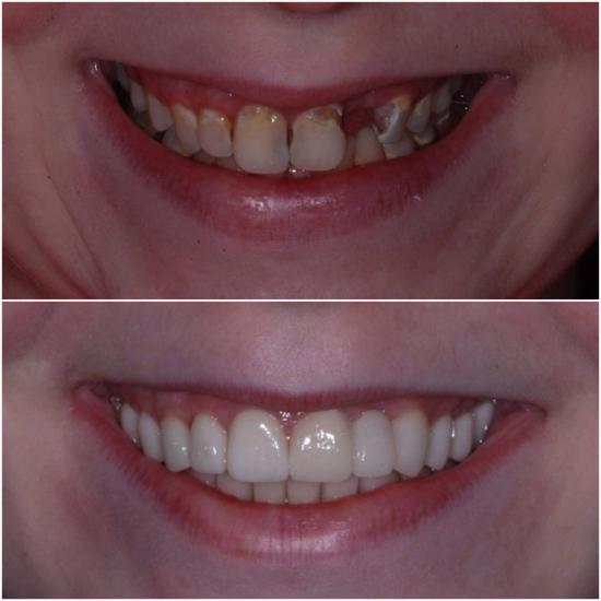 Before and after showing damaged teeth transformed into a bright, even smile.