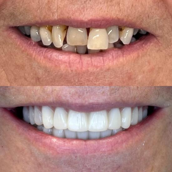 a before and after photo of a man 's teeth .