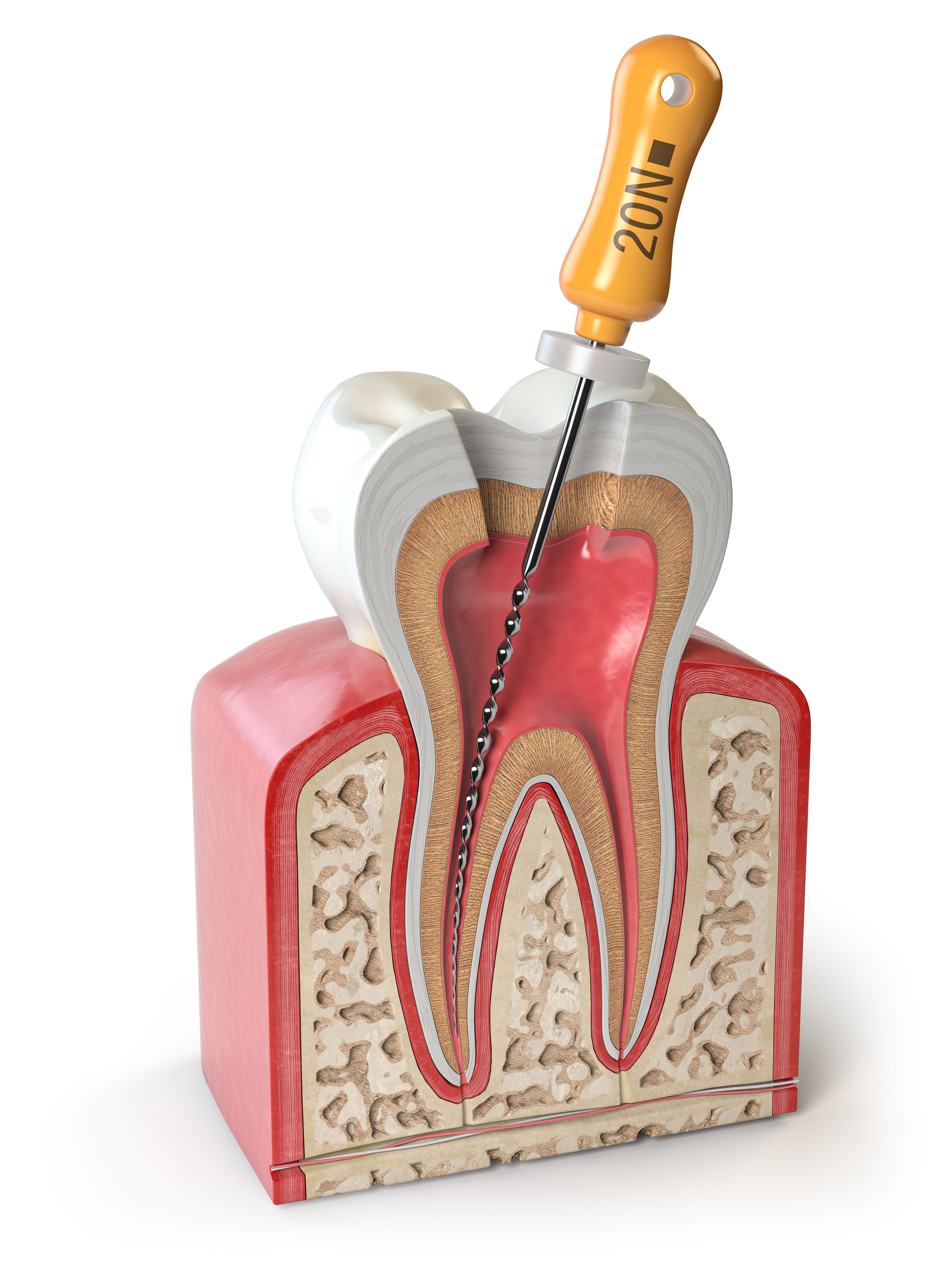 Anatomical cross-section of a tooth with a dental root canal file inside the pulp chamber and canal.