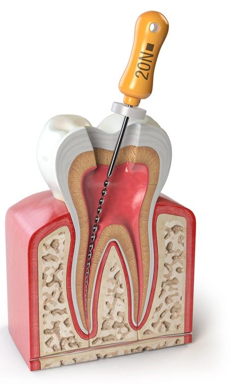 Anatomical cross-section of a tooth with a dental root canal file inside the pulp chamber and canal.