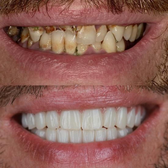 a before and after photo of a man 's teeth .
