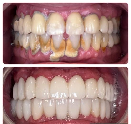 a before and after picture of a person 's teeth .