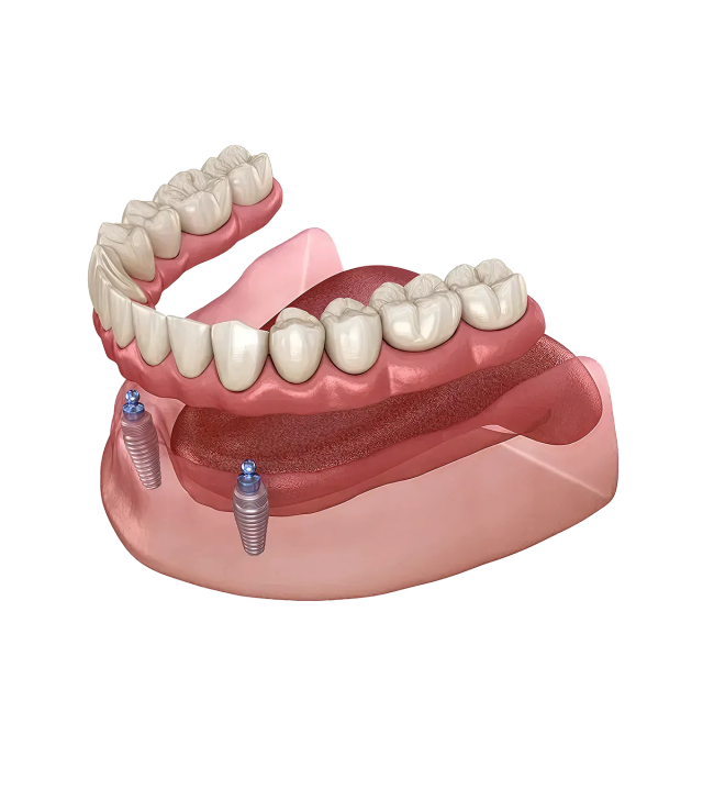 3D illustration of upper and lower dental arches with dentures, the lower set secured by two implants.