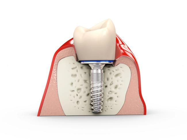 a 3d rendering of a dental implant being placed in a tooth .