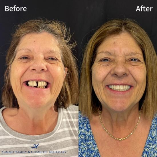 Before and after: A woman's smile transforms from damaged and gapped teeth to a full, bright, even set.