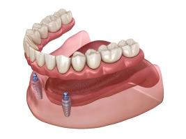 a 3d rendering of a full denture with dental implants .