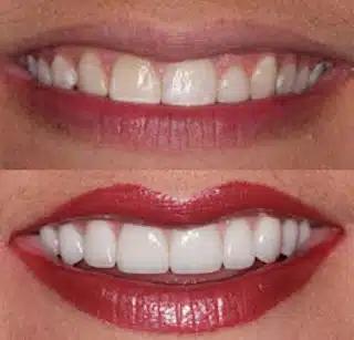a before and after picture of a woman 's smile with white teeth and red lips .