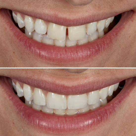 a before and after picture of a person 's teeth .