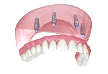 a 3d rendering of a full denture with dental implants .