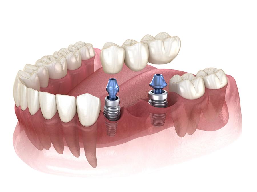 a 3d rendering of a dental bridge with two dental implants .