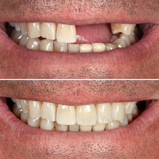 a before and after picture of a man 's teeth .