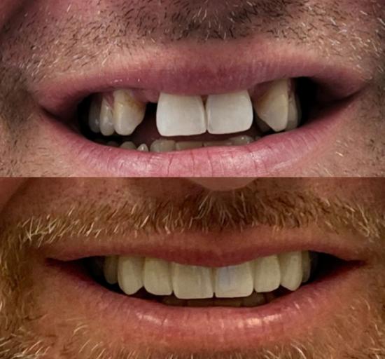 a before and after picture of a man 's teeth .