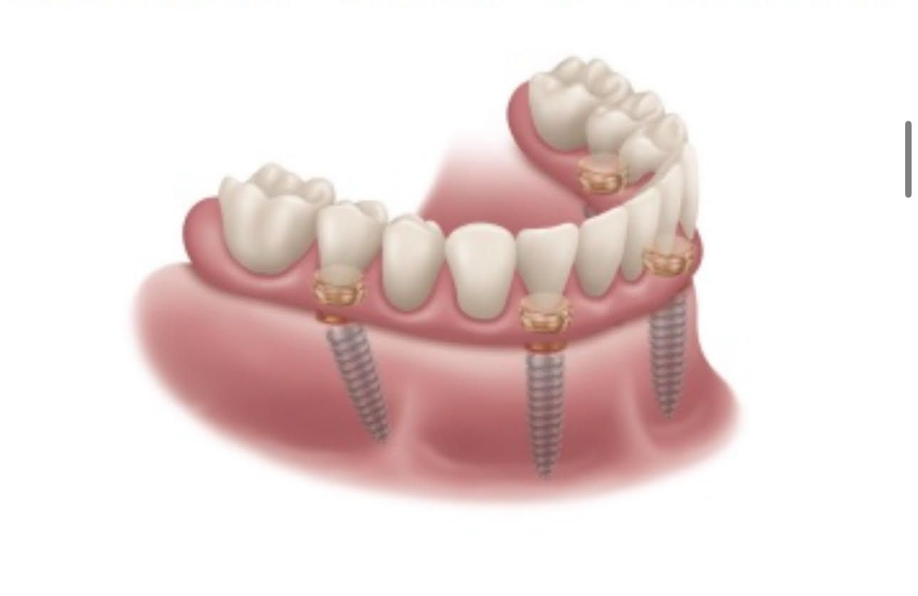 a drawing of a denture with screws in it .