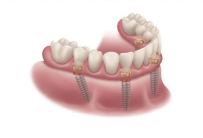 a drawing of a denture with screws in it .