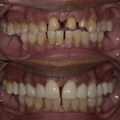 Before and after close-up of a mouth showing a dental transformation from worn, discolored, and gapped teeth to bright white, even, and restored teeth.