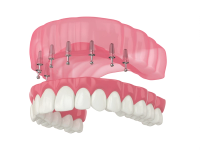 Full lower denture and an upper gum model with six dental implants.