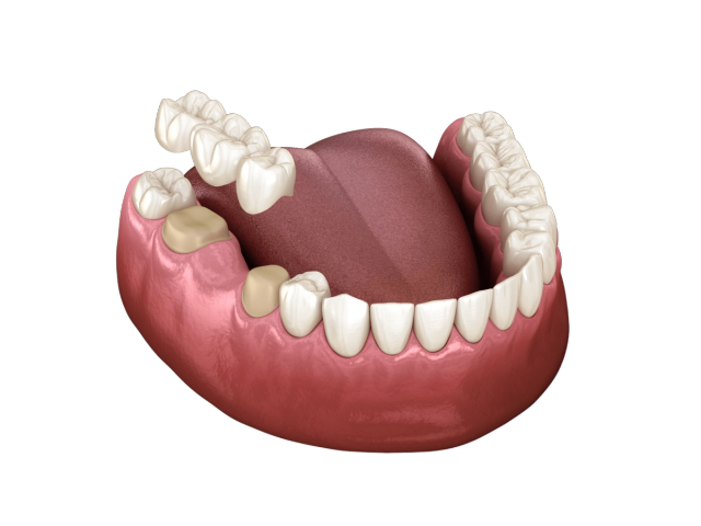 a computer generated image of a mouth with a tooth missing