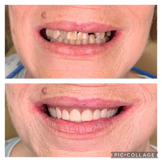 a before and after photo of a woman 's teeth .