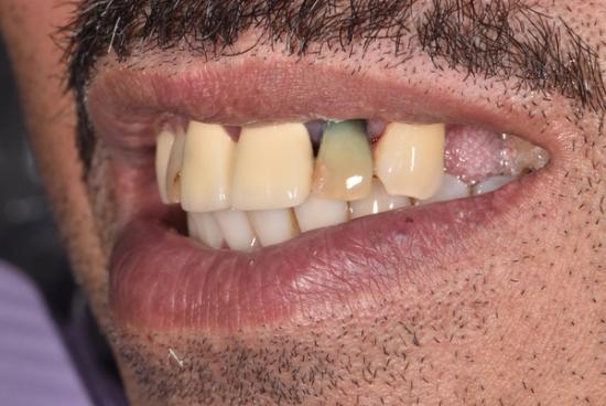 a close up of a man 's mouth with a missing tooth .