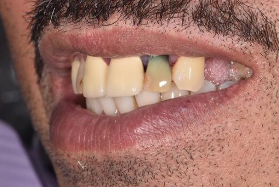 a close up of a man 's mouth with a missing tooth .