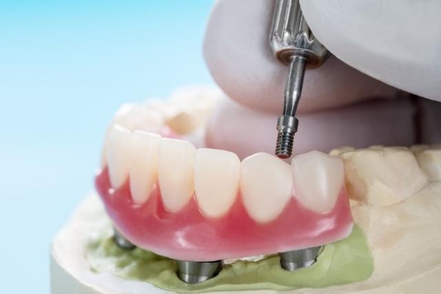 a dental implant is being inserted into a denture on a model .