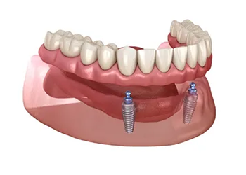 a computer generated image of a denture with dental implants .
