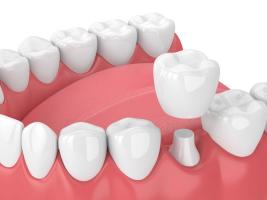 3D rendering of a dental crown installation.