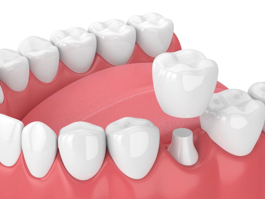3D rendering of a dental crown installation.