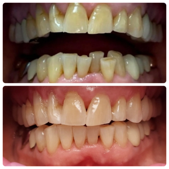 a before and after picture of a person 's teeth