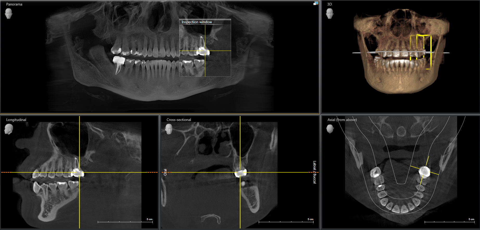 a x-ray of a person 's teeth is shown with the words cross sectional and actual bone visible
