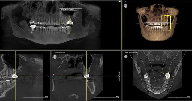 a x-ray of a person 's teeth is shown with the words cross sectional and actual bone visible