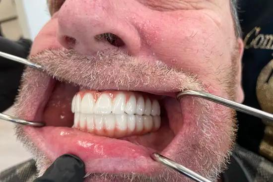 a close up of a person 's mouth with a full denture .