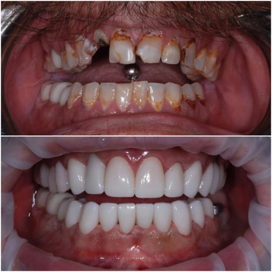 Before and after dental treatment showing decayed and missing teeth above, and a full set of bright white, healthy teeth below.
