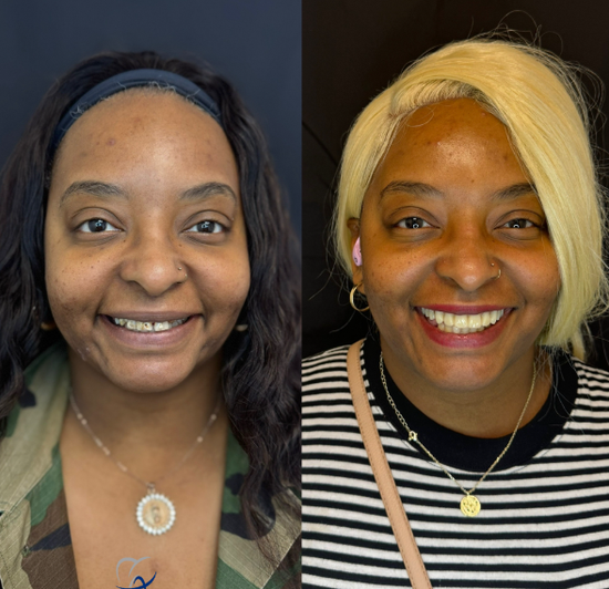 Before and after of a woman's smile transformation, showing misaligned teeth on the left and straight, white teeth on the right.