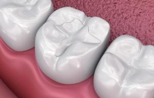 a close up of a tooth with a filling in it .